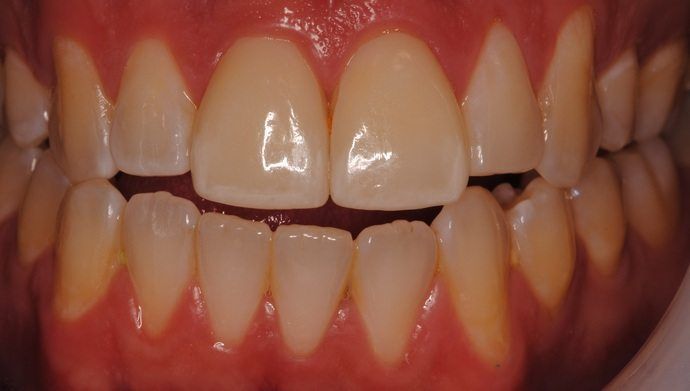 Close-up view of a person's teeth, showing a full set of white upper and lower teeth.