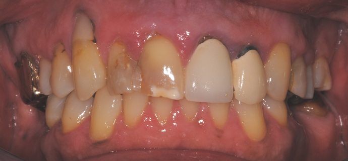 A close-up view of a mouth with teeth in various states of decay and a dental crown. The gums are inflamed.