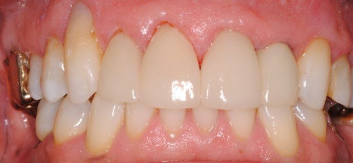 Close-up of a person's upper teeth. The teeth are mostly white with some gold crowns. The gums are pink.