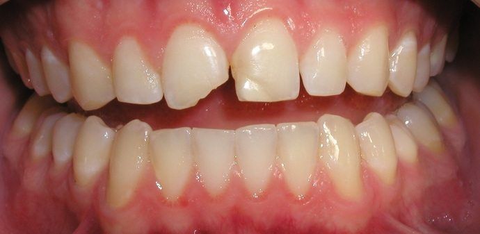 Close-up of human teeth, with one front tooth chipped and broken. The teeth are light in color, set in a pink gumline.