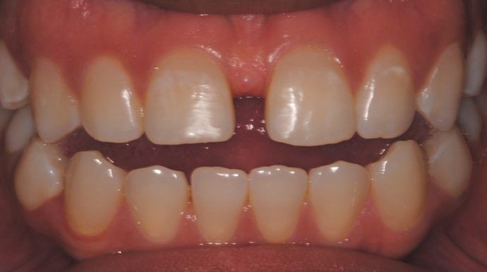 Close-up view of a person's teeth, showing a gap between the two front teeth.