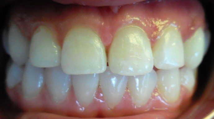 Close-up of a person's teeth, showing healthy gums and light-colored teeth in a straight row.