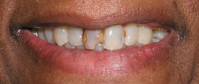 Close-up of a person's smiling mouth, revealing teeth with yellowing and some damage. The lips are full and pink.