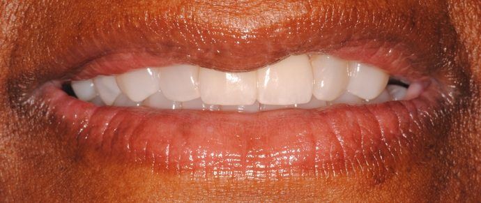 Close-up of a person's mouth with a wide smile, showing white teeth and dark skin. The person is smiling with their lips parted.