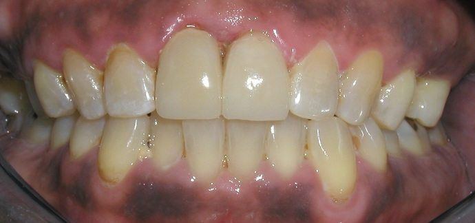 Close-up of teeth with a few crowns in a mouth, showing the upper and lower sets. The teeth are various shades of white and yellow.