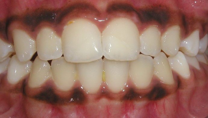 Close-up of human teeth with dark discoloration around the gum line, contrasting with the bright white teeth.