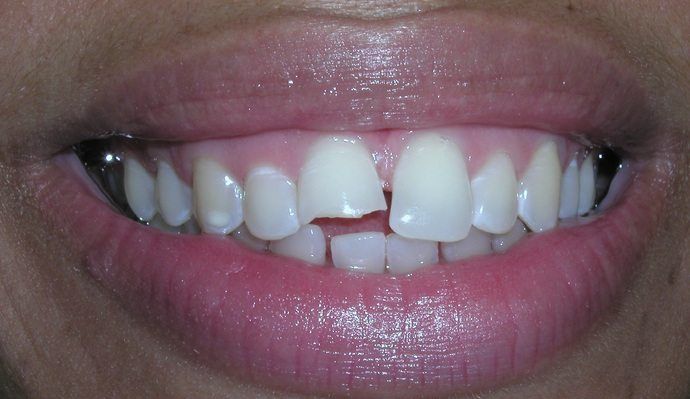 Close-up of a person's mouth with a chipped front tooth. The teeth are white, and the lips are a pale pink.