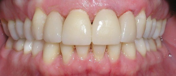 Close-up of a mouth showcasing a set of teeth with visible gums. The teeth are a bright, unnatural white, contrasting with the pink of the gums.