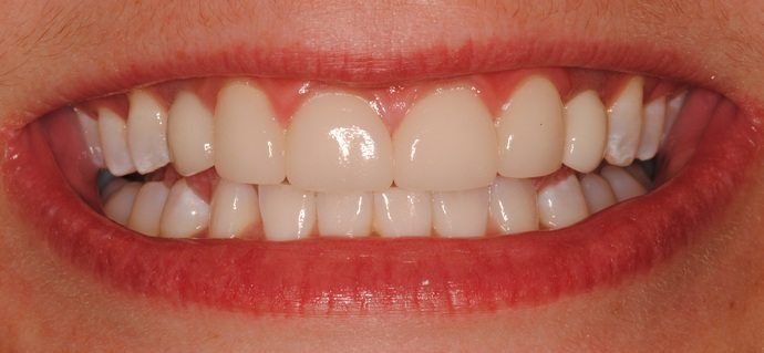 Close-up of a person's smiling mouth, showing straight, white teeth and red lips.