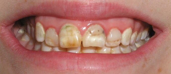 Close-up of a person's mouth, showing discolored and damaged teeth. The teeth have a yellow and brown tinge, and some appear chipped. The gums are slightly pink.