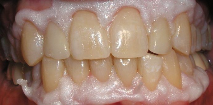 Close-up of a person's teeth, with a whitening agent applied to the surfaces. The teeth are a yellowish color.