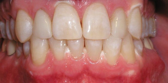 Close-up view of human teeth and gums. Teeth are off-white with visible enamel, and gums are pink and slightly glossy.