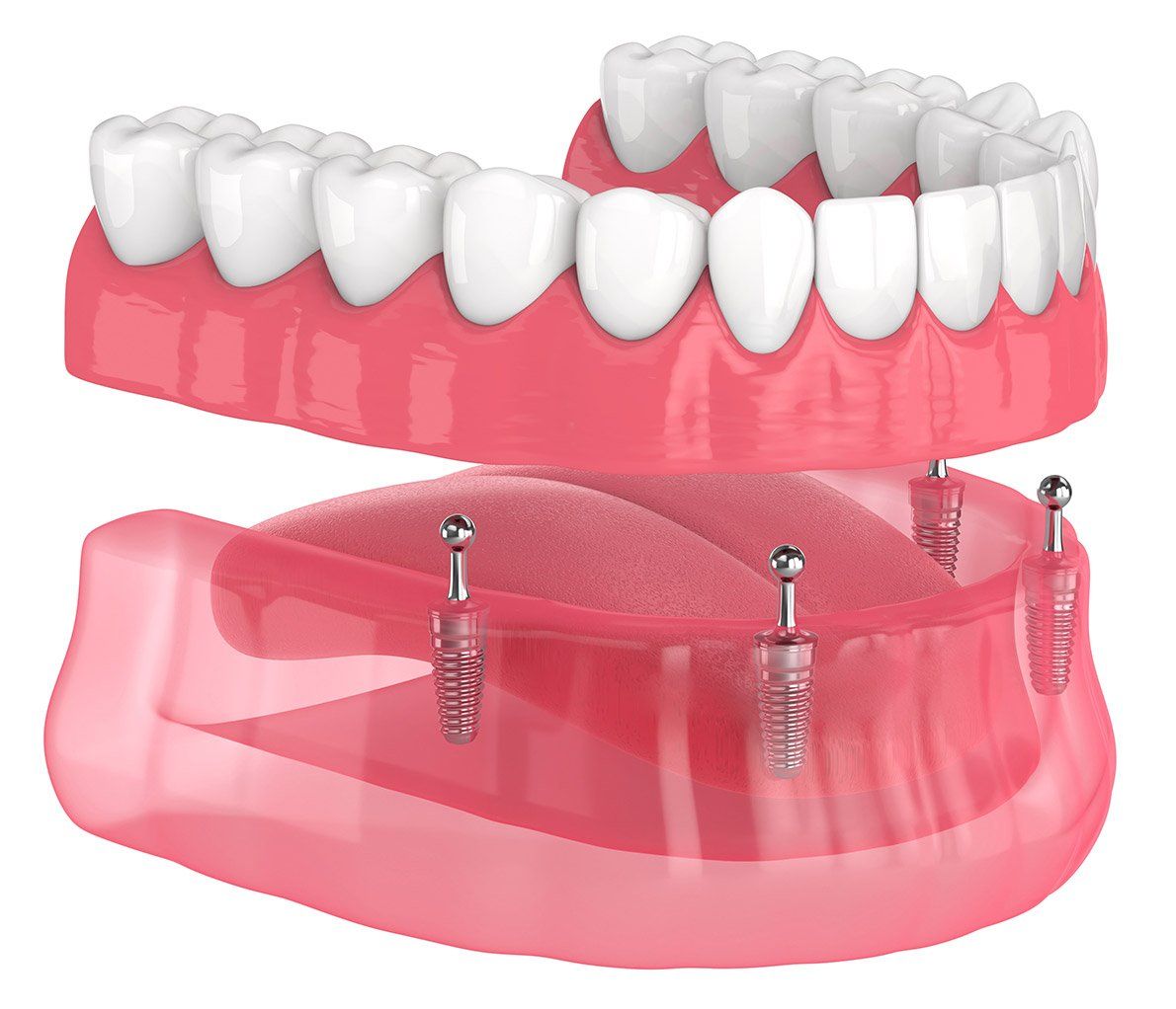 Implant-Supported Dentures in Owings Mills, MD