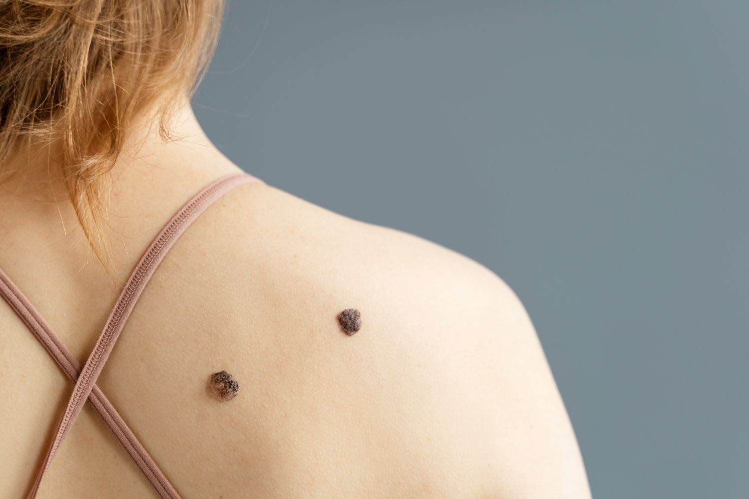 A woman has two black spots on her back.