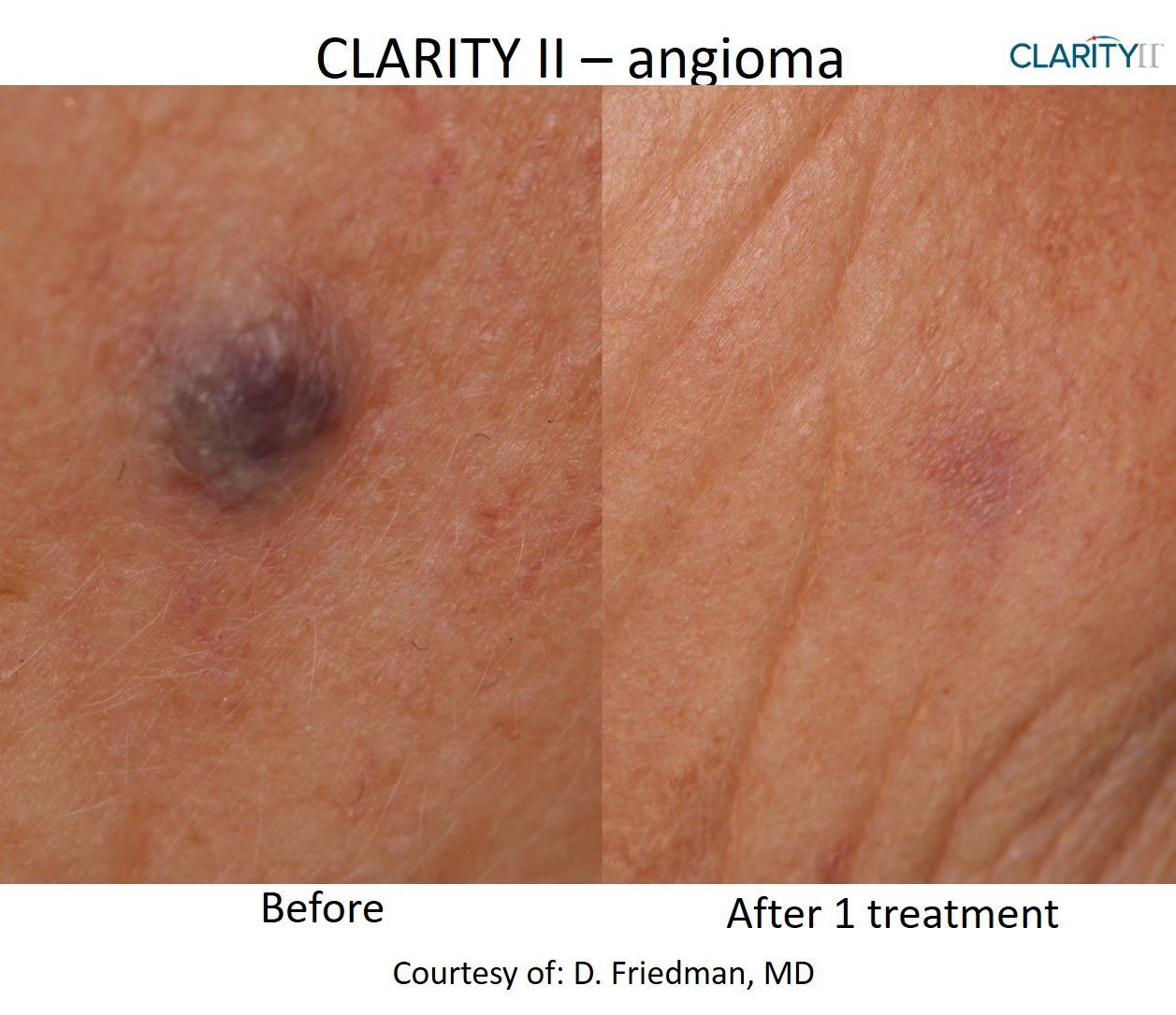 A before and after picture of a clarity ii angioma