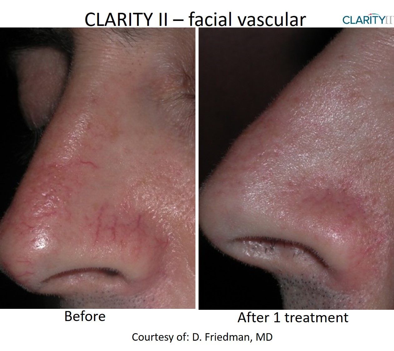 A before and after picture of facial vascular treatment