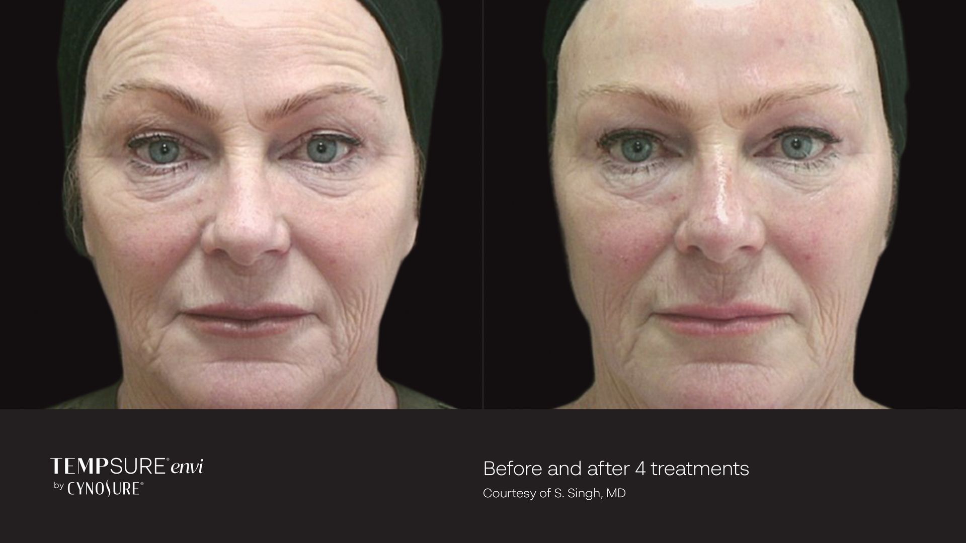 A before and after photo of a woman 's face.