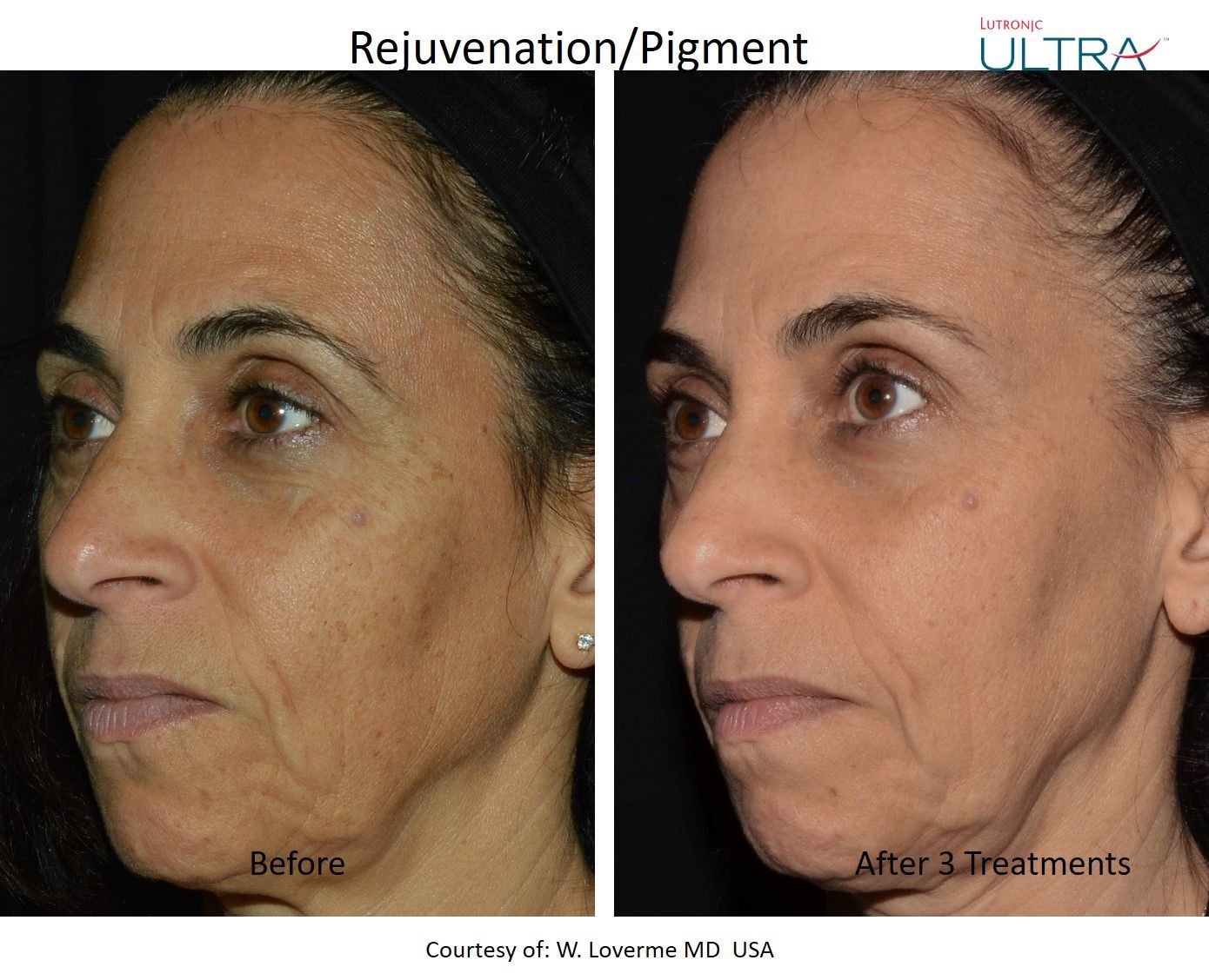 A before and after photo of a woman 's face