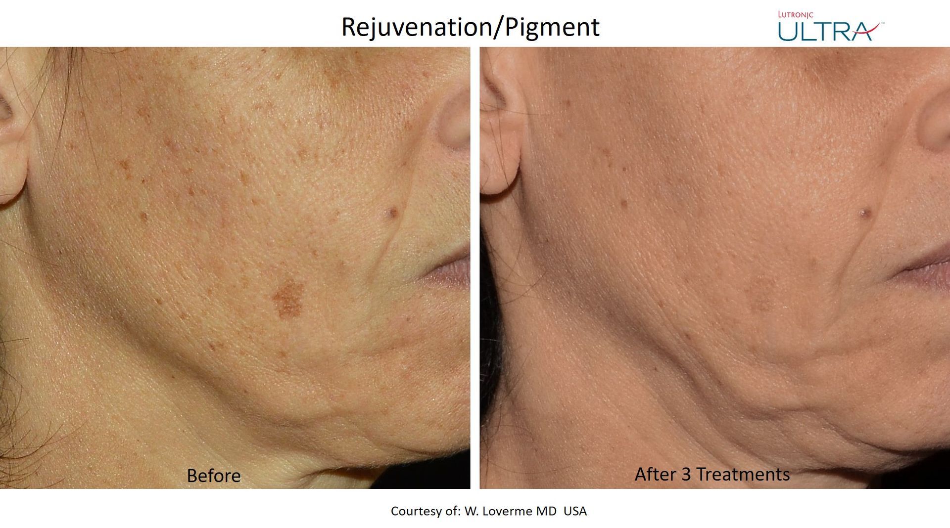 A before and after photo of a woman 's face.
