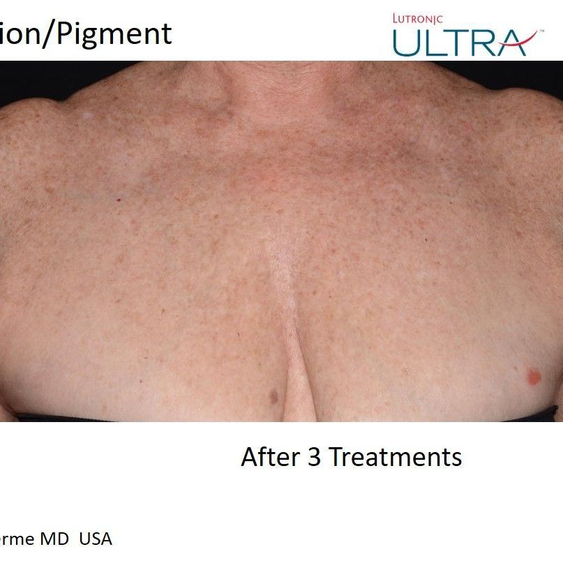 A picture of a woman 's chest after 3 treatments