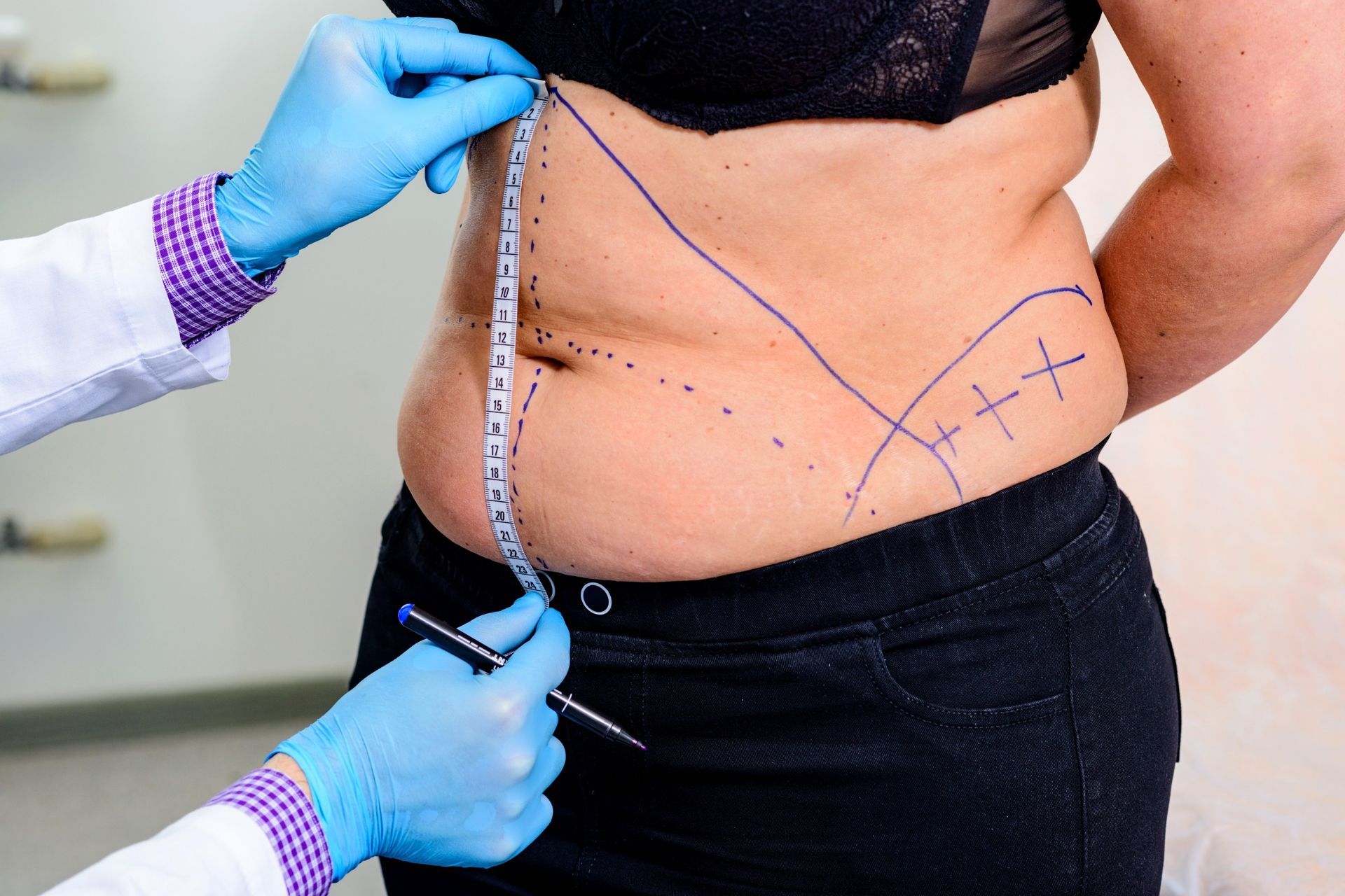 A patient being marked for a tummy tuck procedure by a doctor