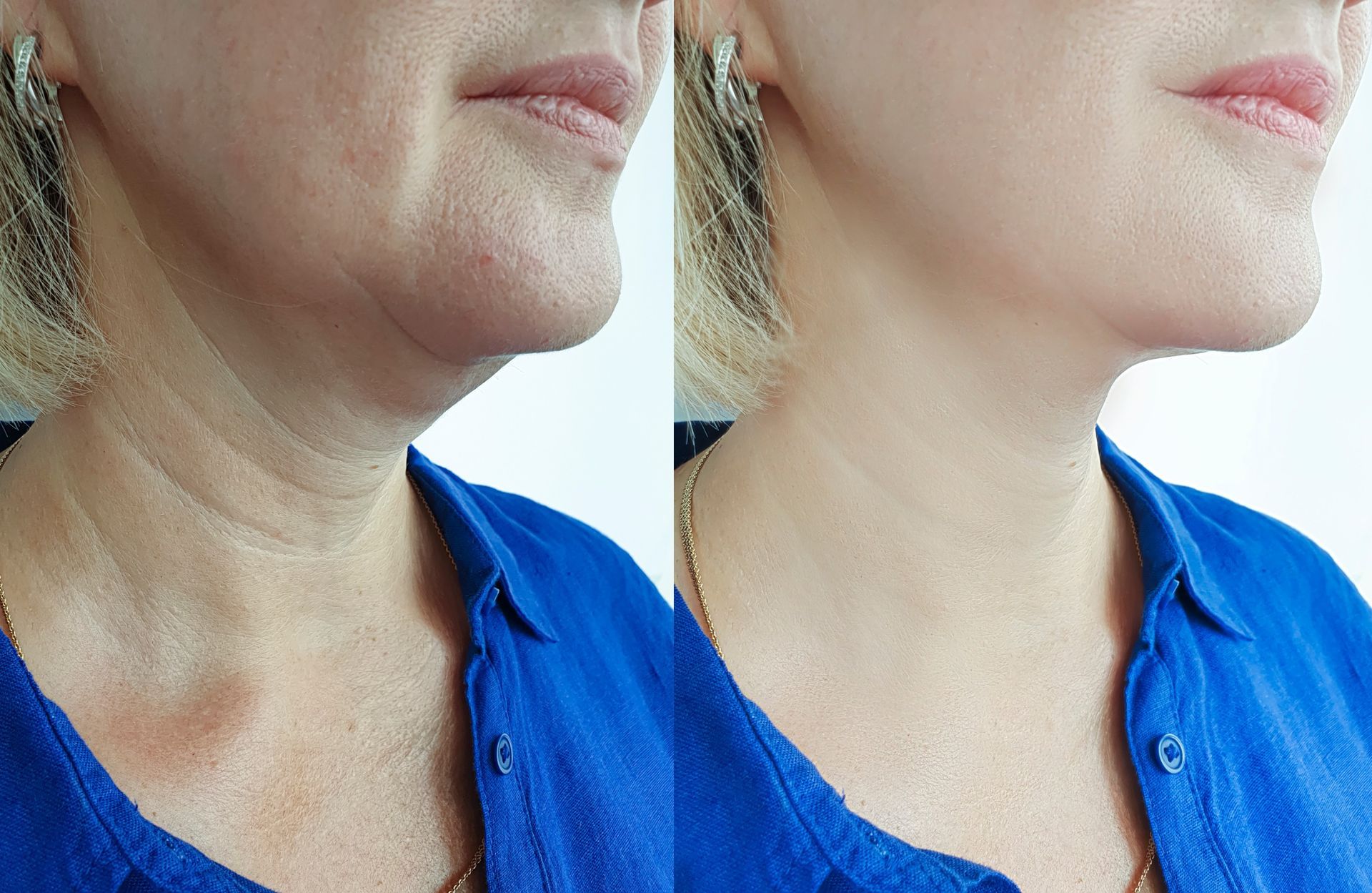 Everything You Need to Know About Neck Lifts