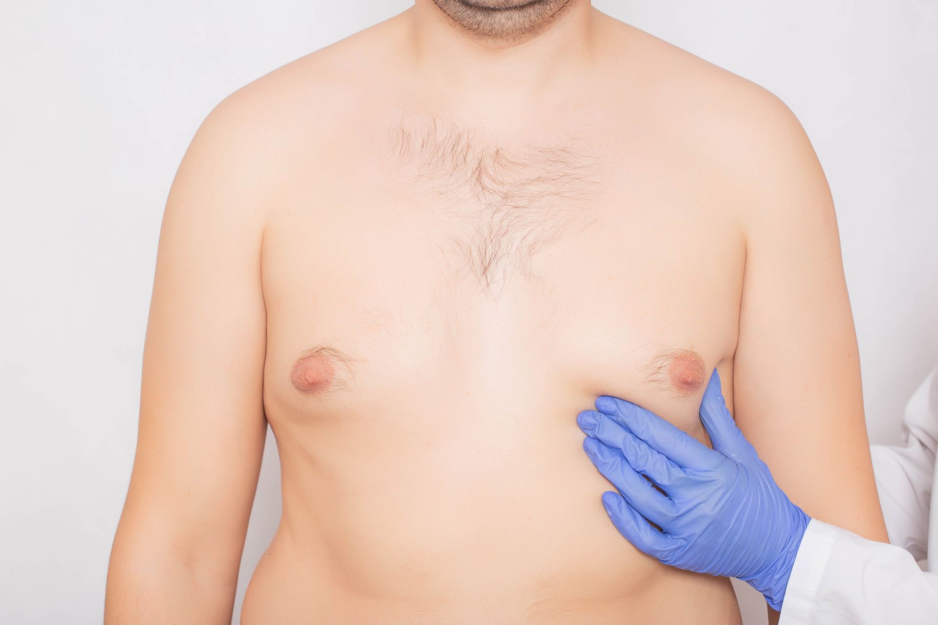 Gynecomastia Surgery