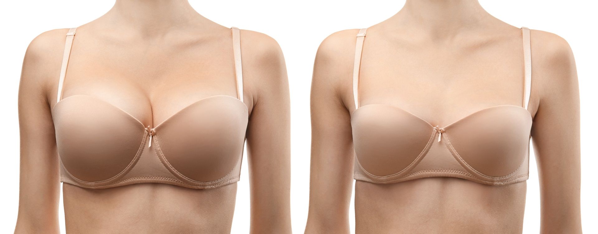 When to Consider Breast Reduction Surgery