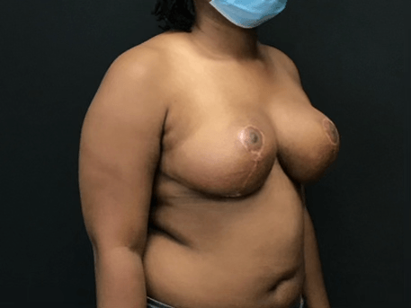 Breast Reduction Surgery in Georgia