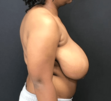 Breast Reduction & Lift in Athens, GA
