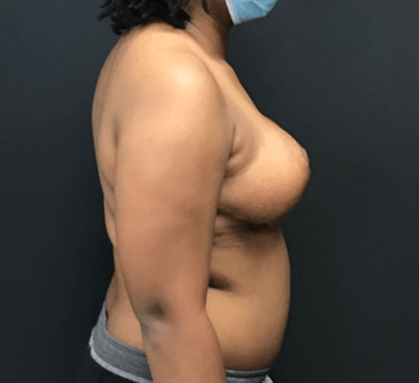Breast Reduction Surgeon in Athens, GA