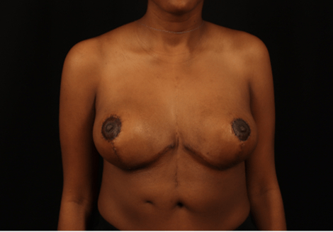 Best Breast Reduction in Athens, GA