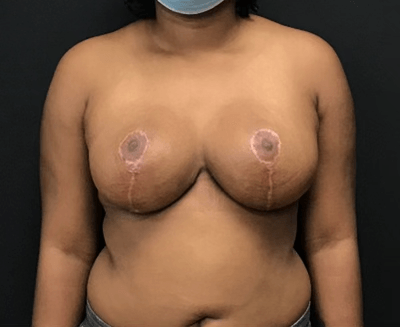 Best Breast Reduction