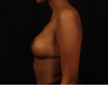 Breast Reduction in Athens