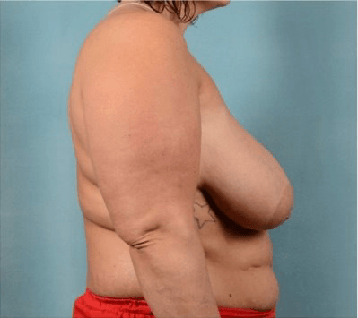 Breast Reduction/Breast Lift