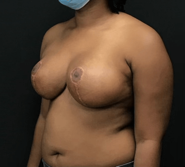 Breast Reduction Surgery near me