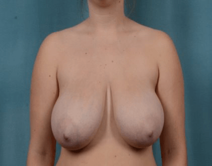 Breast Reduction Surgery near me