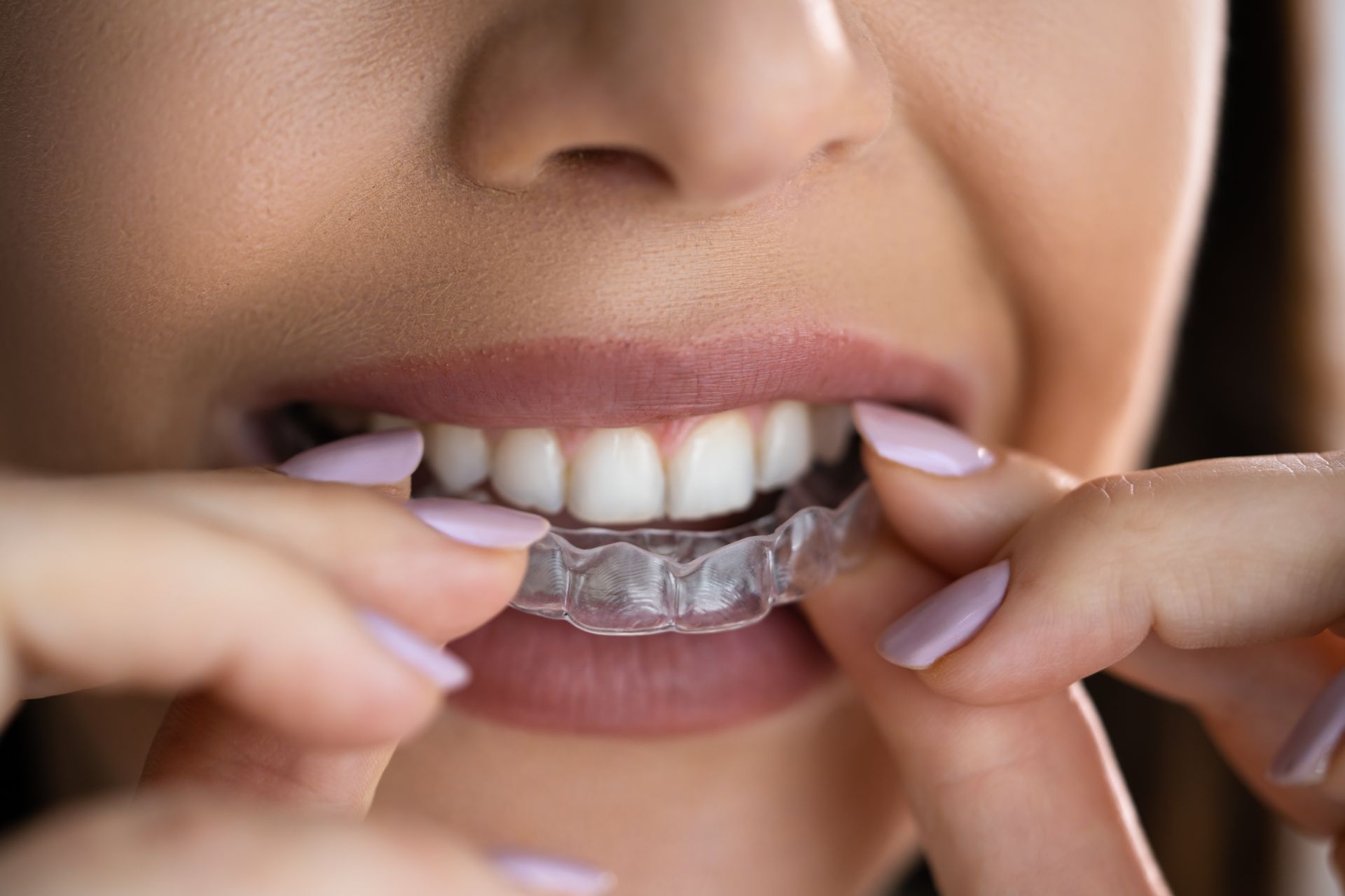 Woman inserting clear aligner over teeth.