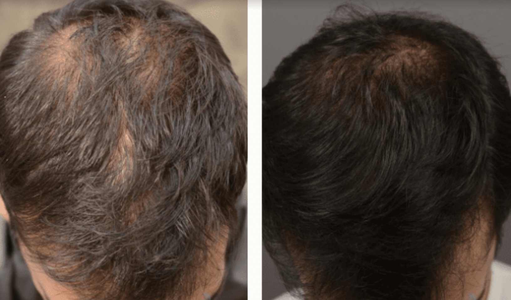 PRP hair restoration before and after pictures