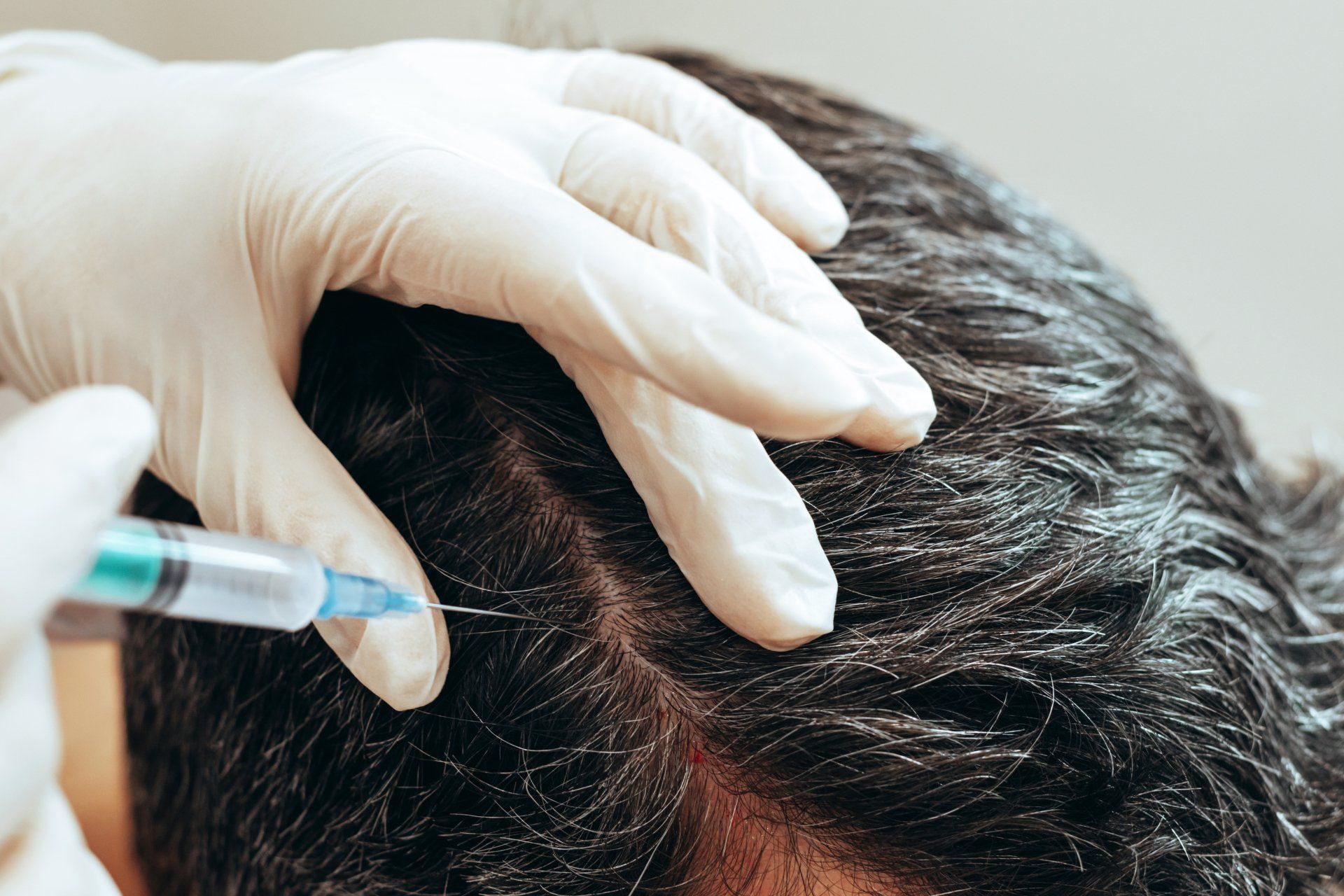 Man receives PRP injection to treat hair loss