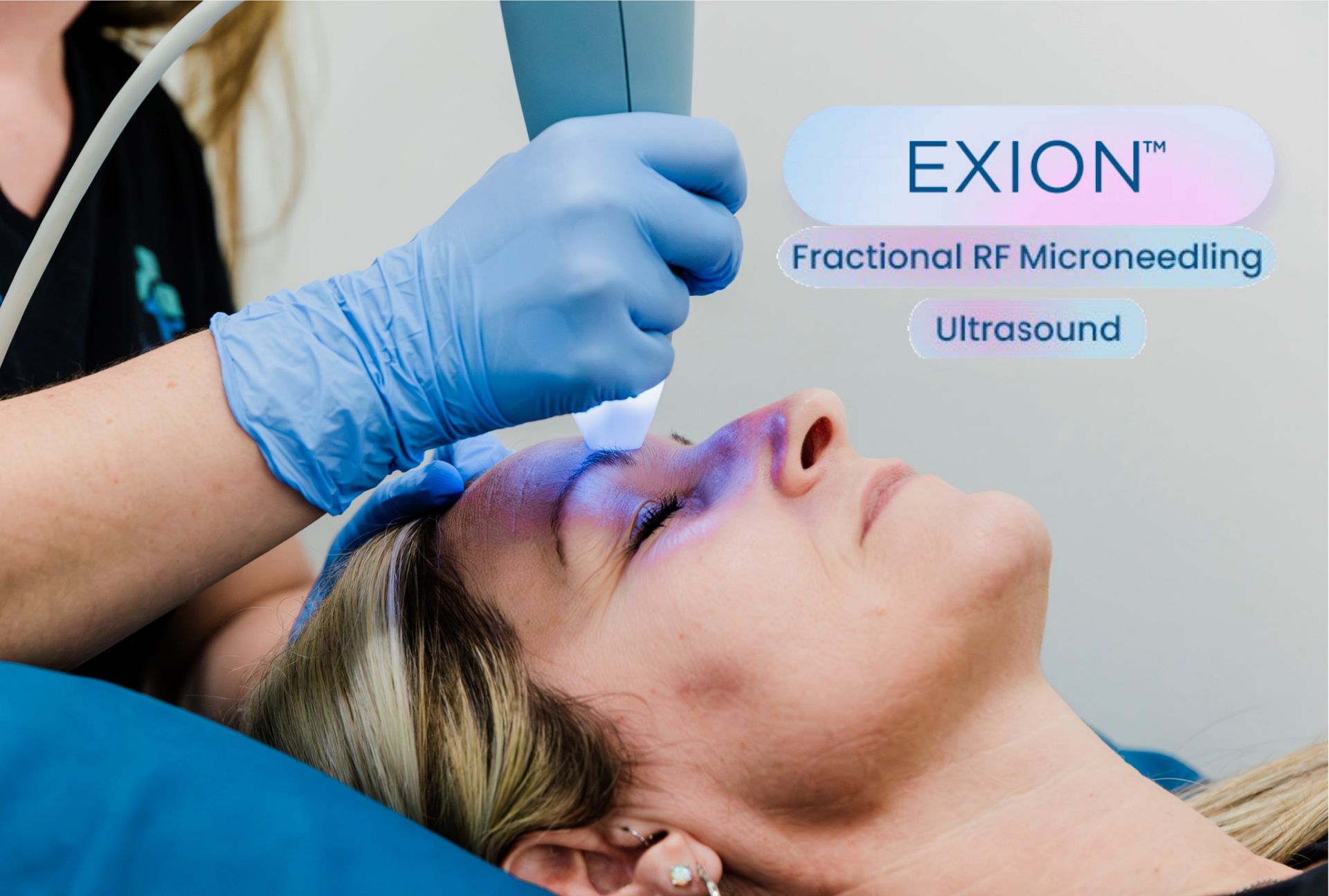 Exion Mircroneedling