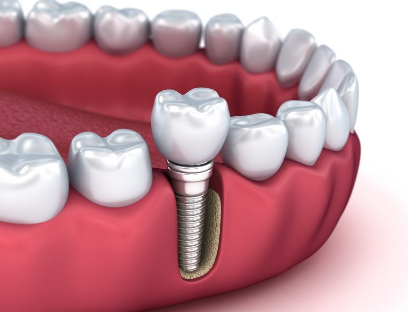 Dental Implants — Turvey Park, NSW — Bright Smiles