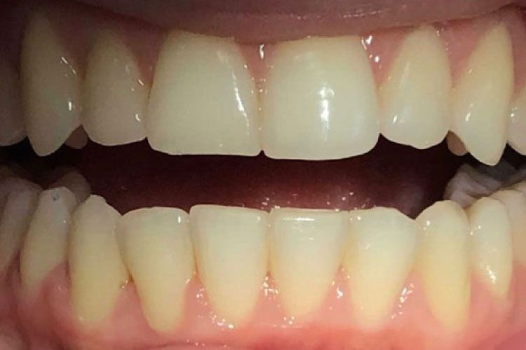 Invisalign procedure after