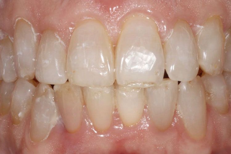 Invisalign procedure after