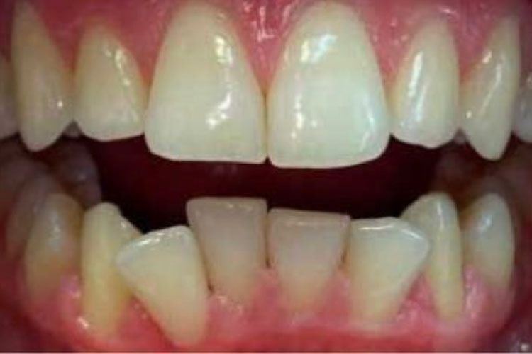 Invisalign procedure before