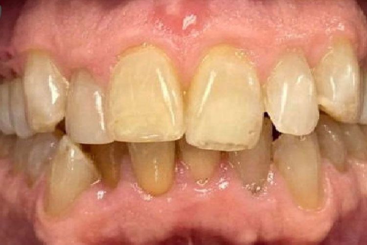 Invisalign procedure before