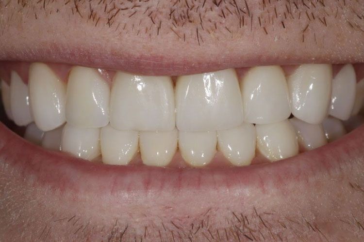 Smile makeover procedure after