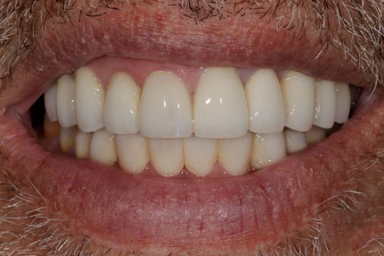 Smile makeover procedure after