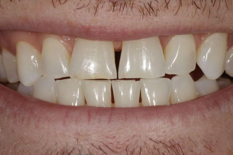 Smile makeover procedure before