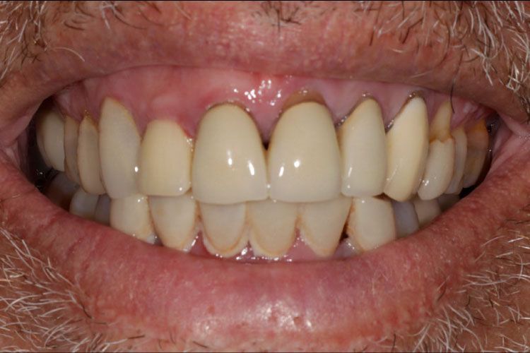 Smile makeover procedure before